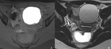 LO MONTE AND COLLEAGUES In most cases, endometriotic lesions have an MRI signal intensity that comes very close to that of the surrounding fibromuscular structures.