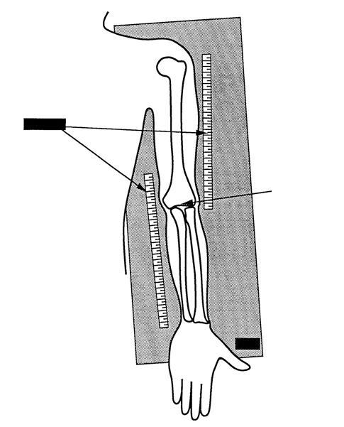Distal Humeral Proximal Ulna Procedure Specifics: AP and Lateral of both arms and hands elbow to metacarpals AP entire lengths of both humeri epicondyles equidistant ML entire lengths of both humeri