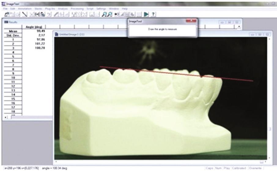 Amorim JR, Macedo DV, Normando D Figure 3 - Photograph of the plaster mold exported to the graphic software used to obtain the measurements of the dental angulations.
