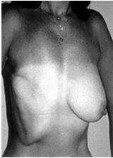 (19%), Allodynia (15%) Mejdahl et al BMJ2013:346:f1865 Already known: after treatment for breast cancer 25-60% of women experience persistent