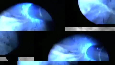 Endomicroscopy of the resection bed
