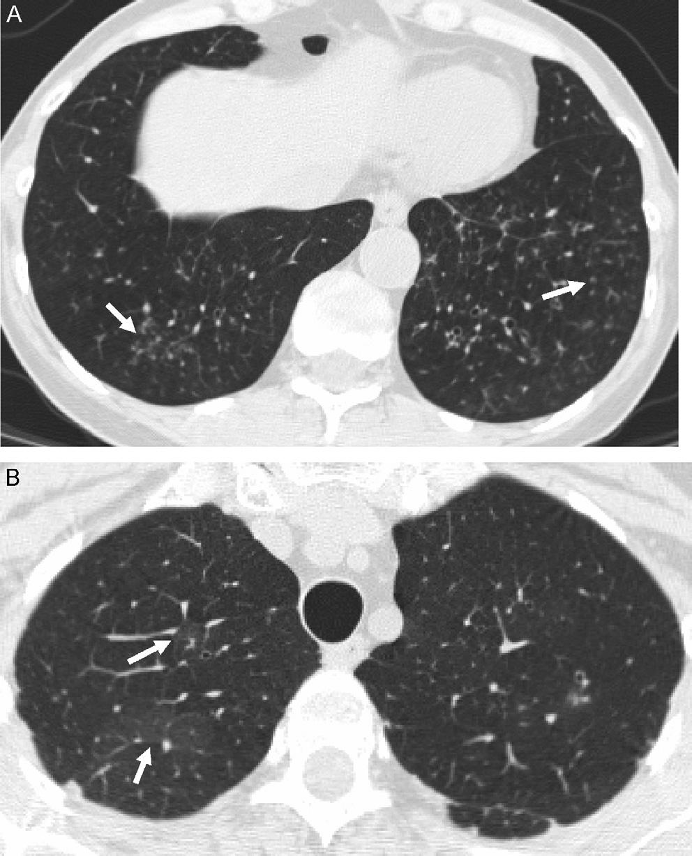Follicular bronchiolitis in surgical lung biopsies 311 Figure 1 High-resolution CT of a 53-year-old woman with follicular bronchiolitis confirmed on surgical lung biopsy.