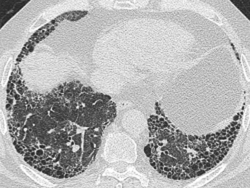 Classical Usual interstitial pneumonia pattern on HRCT ILDs may present acutely, as in acute drug reactions, ARDS or the early stages of extrinsic allergic alveolitis, but more often the natural