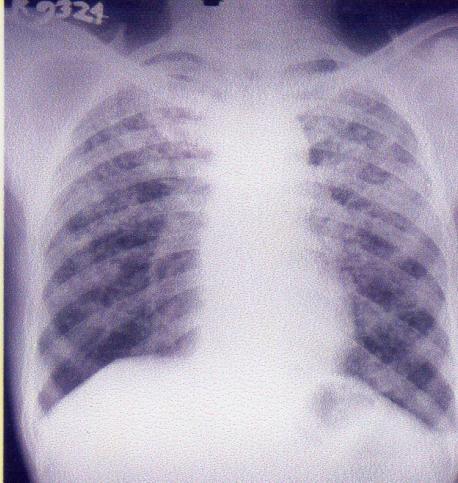fibrosis CxR PA view shows diffuse reticular