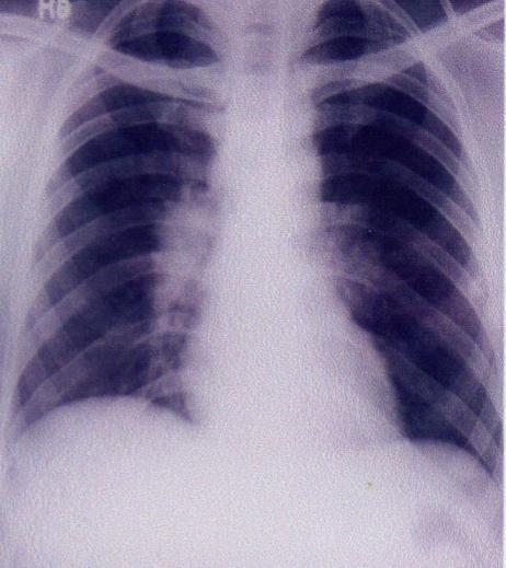 Case 4: A case of Sarcoidosis a) CxR PA view shows bilateral