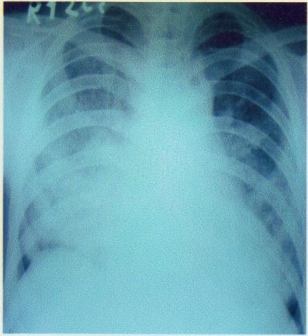 CxR PA view shows patchy areas of consolidation at bilateral