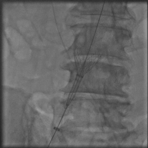CoreValve ejected from the sheath during