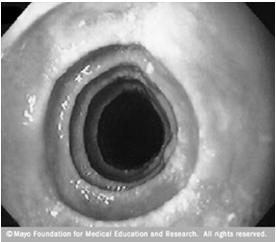 Typical Endoscopic Features Longitudinal mucosal furrowing Trachealization (macroscopic fixed esophageal rings) Mucosal friability White exudates (representing microscopic eosinophilic abscesses)