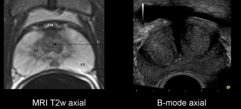 Fig. 3: T2 TSE axial image of the prostate of young patient.