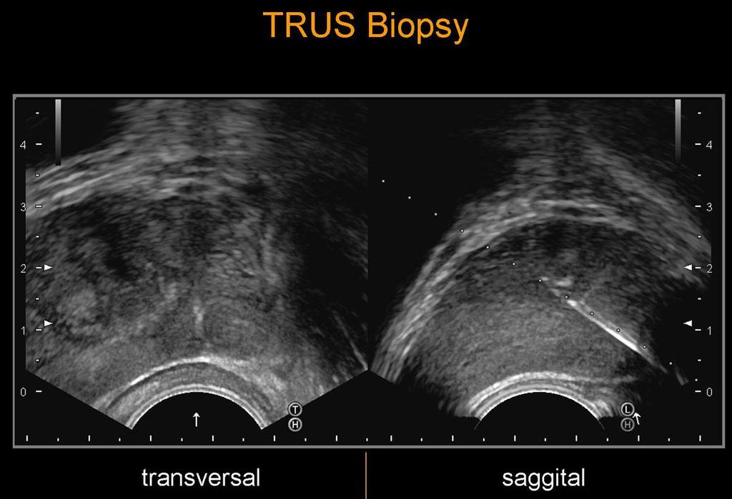 Fig. 6: Biplane TRUS biopsy enabling simultanous visualisation of the
