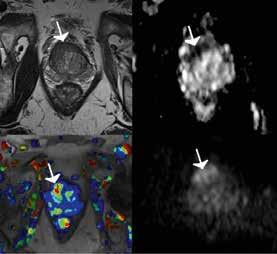 CLINICAL MRI IN PROSTATE CANCER detection of Gleason 4 disease. However, the same study found that the specificity of mpmri was much lower at 40%.