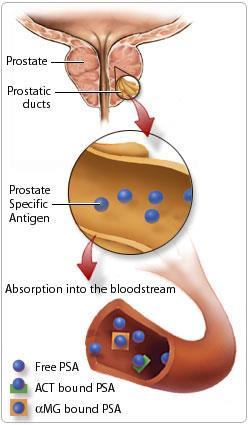 Prostate-Specific Antigen (PSA) PSA is a protein secreted by the epithelial cells of the prostate gland PSA is secreted in the ejaculate, where allows the sperm to swim