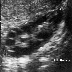 Transvaginal sonography 10-12