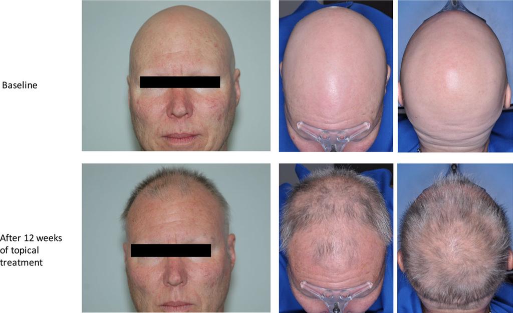 Bokhari and Sinclair Treatment of alopecia areata with topical JAK inhibitors Report 3 Graph 1 treatment of myeloproliferative disorders.