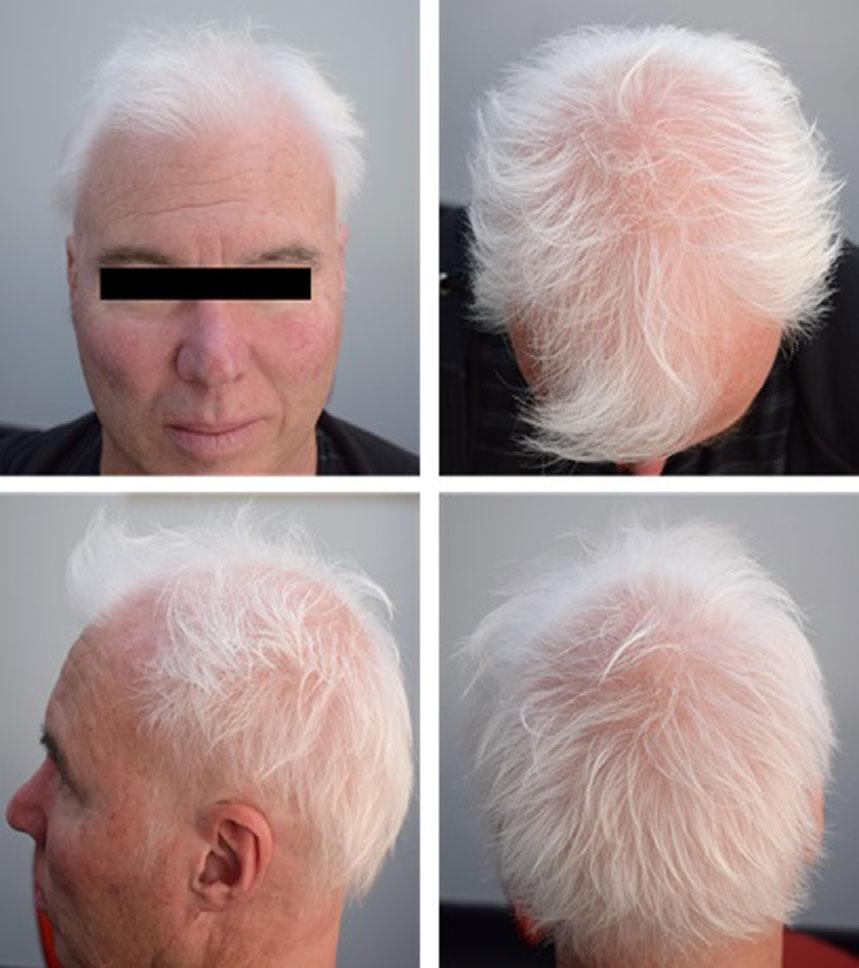 4 Report Treatment of alopecia areata with topical JAK inhibitors Bokhari and Sinclair twice daily have both been examined in phase I clinical trials in the treatment of psoriasis, and tofacitinib