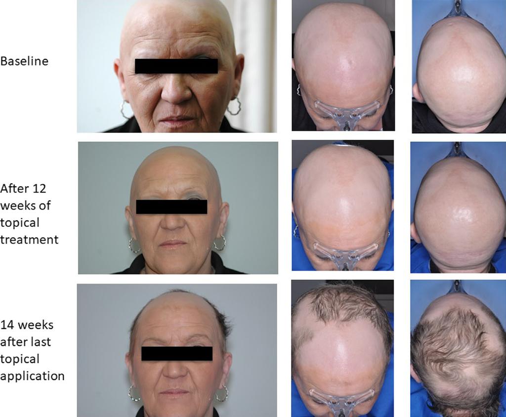 Bokhari and Sinclair Treatment of alopecia areata with topical JAK inhibitors Report 5 patient s scalp vertex and frontal scalp were captured at every visit and assessed by an independent assessor.