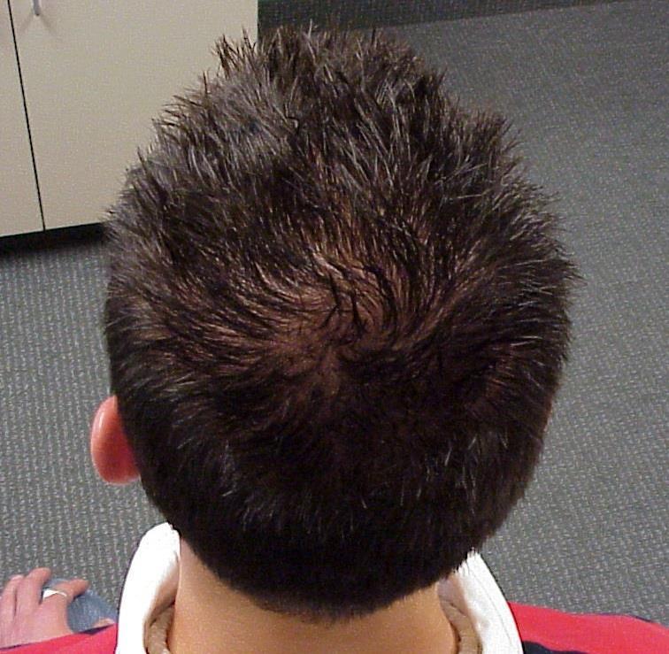 Androgenic/Androgenetic Alopecia Male pattern baldness Complain of thinning vs.