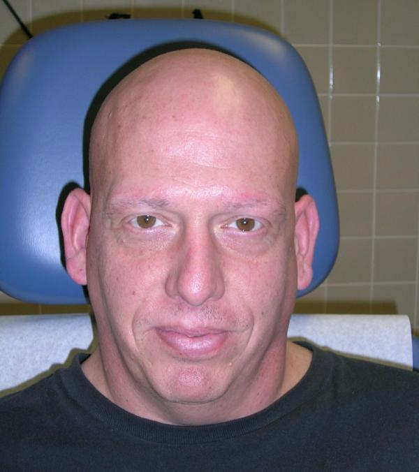Alopecia Areata Usually circumscribed patches