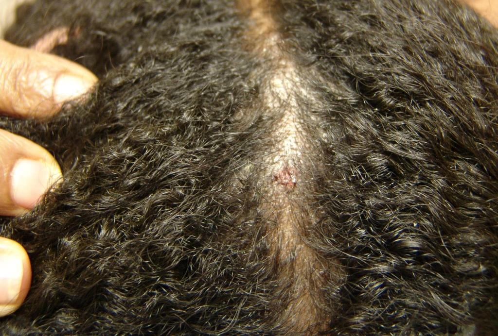 Child with patchy hair loss, scale