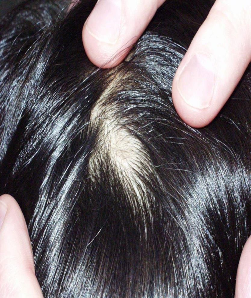 Can be total, diffuse, patchy, or localized Celestino FS, Alopecia.