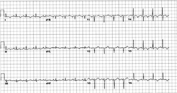 Electrocardiogram Left Ventricular hypertrophy - widened QRS Sinus tachycardia Arrhythmias left atrial