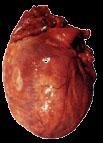Definition - PPCM - Dilated cardiomyopathy of unknown cause