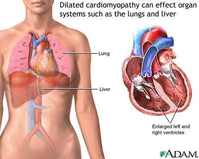PPCM - Symptoms of congestive heart failure Shortness of breath Fatigue Cough