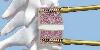 implant placement (Courtesy of Synthes Spine, West Chester, Pennsylvania) Figure 11.