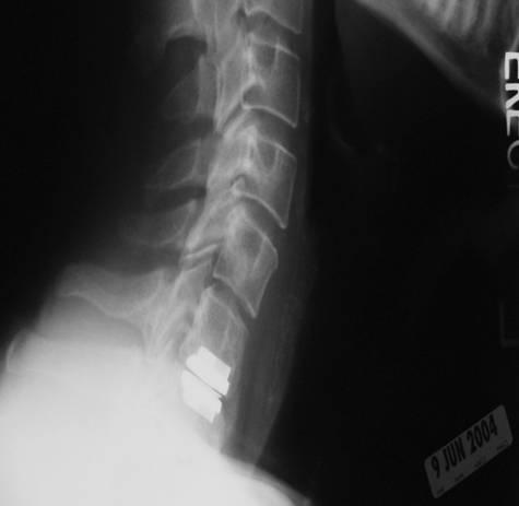 Cervical Disc Arthroplasty A Clinical Review http://dx.doi.org/10.5772/61128 99 A brief search of the literature identified two case reports of local inflammatory response in the setting of CDA.