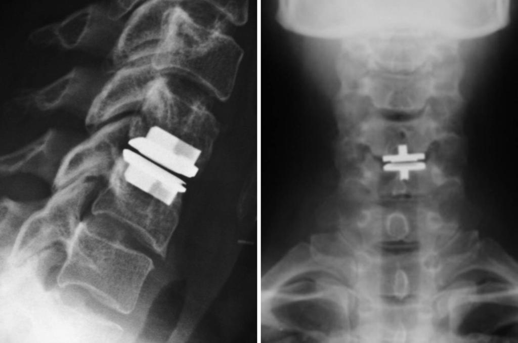 Cervical Disc Arthroplasty A Clinical Review http://dx.doi.org/10.5772/61128 89 Figure 7. AP and lateral radiographs of a ProDisc-C 4.