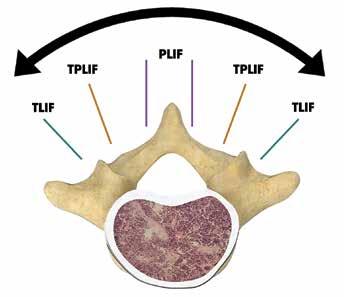 The following technique describes the unilateral insertion of a single implant into the disc space through a posterior lumbar interbody fusion (PLIF) approach, transforaminal lumbar interbody fusion