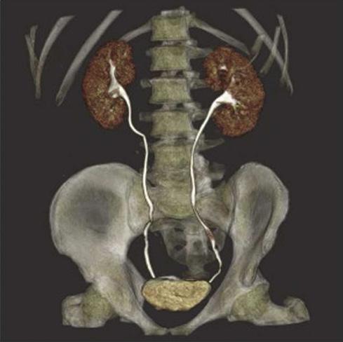 Radiation oncology CT scans from the BodyTom can help radiation oncologists design