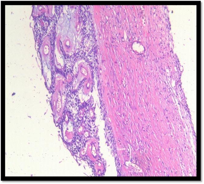Under low power view (10X), H & E stained tissue section showed cystic cavity lined by odontogenic epithelium.