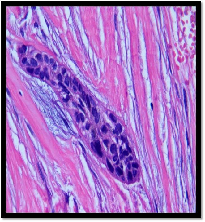 Figure 5- Low power view (H&E stain) demonstrating intraluminal proliferation of odontogenic epithelium in plexiform pattern Under high power view (40X), islands of tall columnar cells with