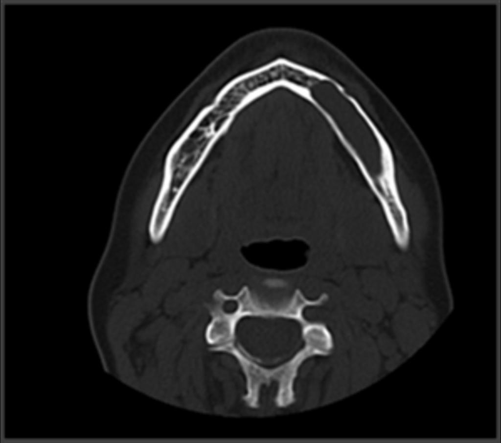 Fig. 2: Axial MDCT of the mandible: ovoid and expansile osteolytic lesion