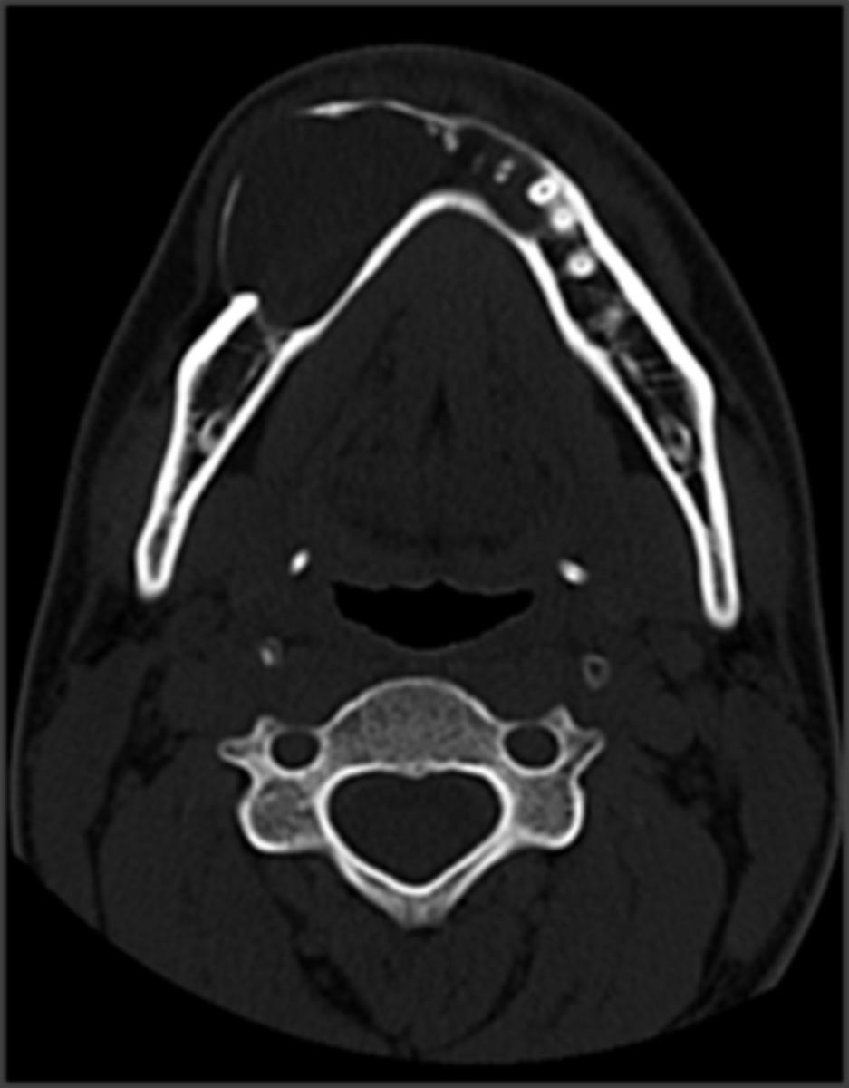 Fig. 4: Coronal reconstruction of bone CT shows an expansile osteolytic