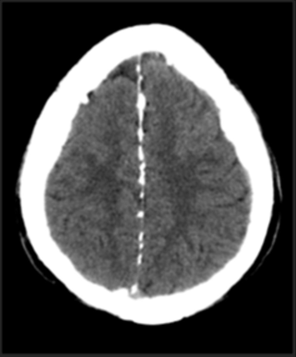 Fig. 7: Axial craneal CT: Patient with Gorlin-Goltz