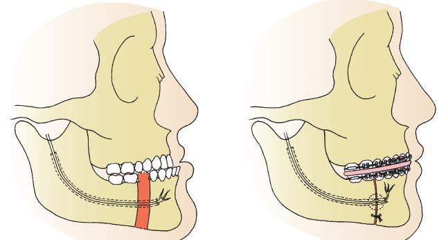 3- Body osteotomy By removing sections of bone in the body of the mandible, which allowed the anterior segment to be moved posteriorly.