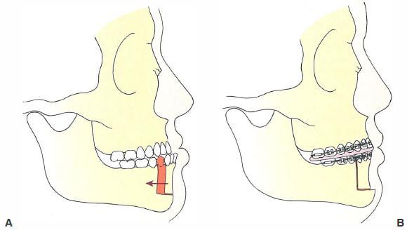 When the reverse overjet relationship is isolated to the anterior area of the mandible, a subapical osteotomy technique can be used for correction of