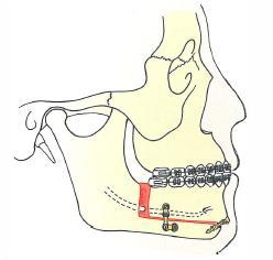 By combining the osteotomy with interpositioned bone grafts, this technique