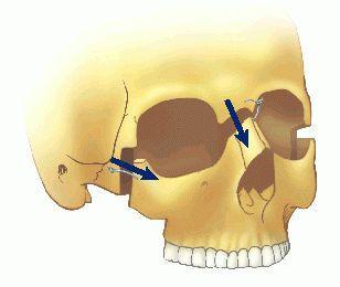 Le Fort III osteotomy Complete craniofacial dysjunction by the LeFort III