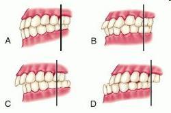 Dental Dysplasias Dental dysplasias are limited strictly to malocclusions that result from abnormal relationship of the dentition and not from the skeletal position of the upper and lower jaws.