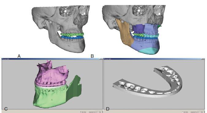 Evaluation of patients with dentofacial deformities A and B, CT and CBCT Three-dimensional imaging and virtual planning.