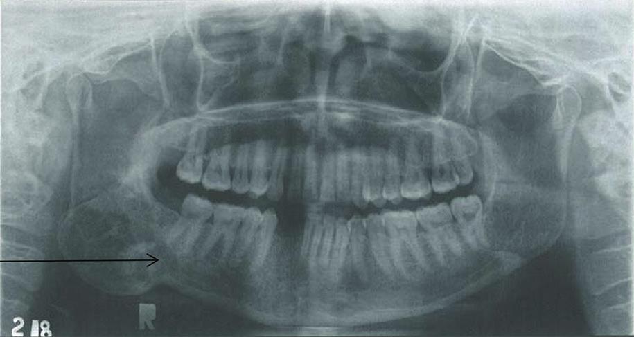 Aneurysmal bone cyst of mandible: A case report and review of literature 435 Fig.