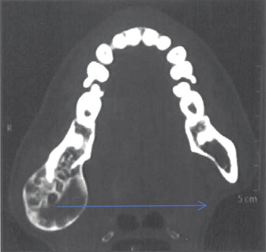 7 Contrast enhanced coronal CT scan (second visit: October 2008) coronal CT showing expansion & thinning of buccal & lingual cortex with irregular breaks. Fig.