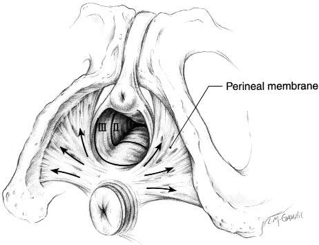 816 DeLancey April 1999 A Fig 1. A, Peripheral attachments of perineal membrane to ischiopubic rami and direction of tension on fibers uniting through perineal body (arrows).