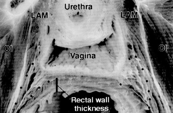 contralateral side (asterisk). In B note origin of endopelvic fascia from superior fascia of levator ani muscle (LAM). OI, Obturator internus muscle; URETH, urethra.