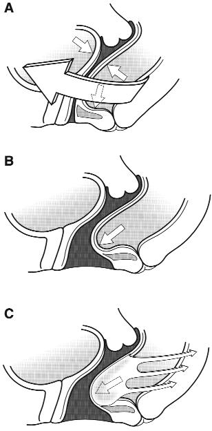 Note difference in this level from level II shown in Fig 4. LAM, Levator ani muscle.