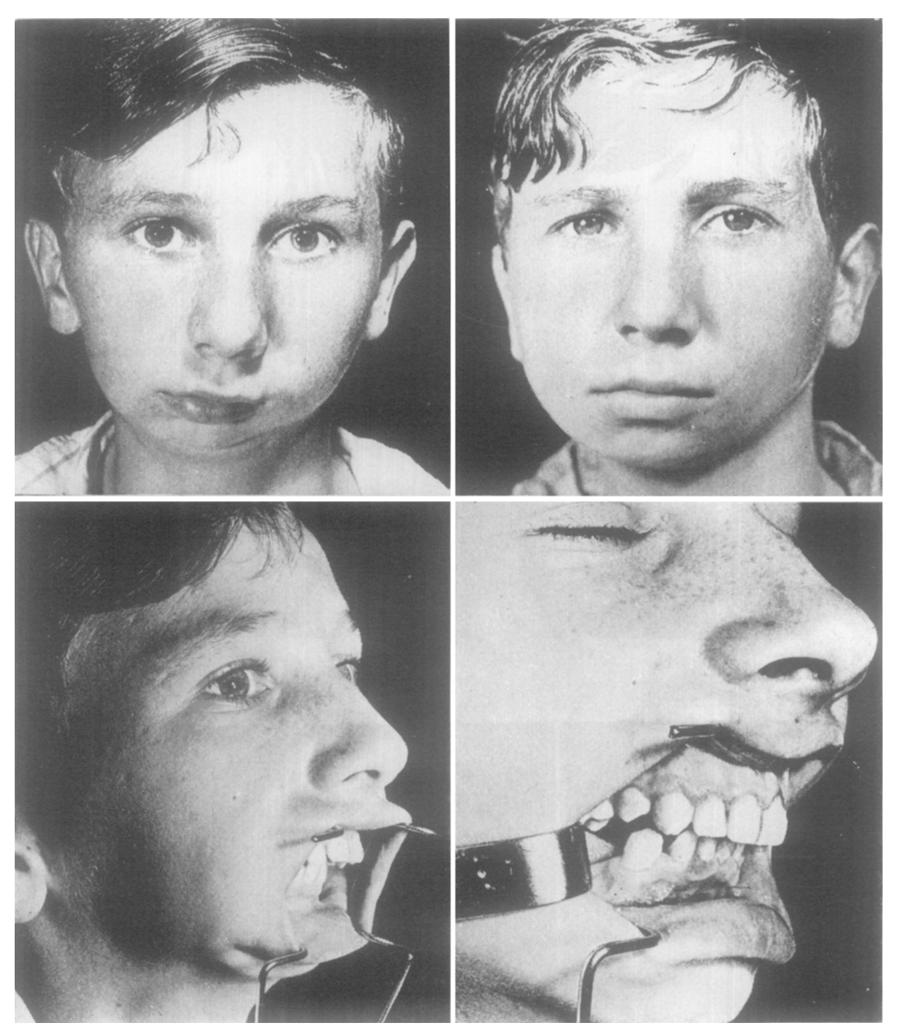 374 RITISH JOURNL OF PLSTIC SURGERY C D Fro. 4 Case 4.--Facial asymmetry due to underdevelopment of the right mandibular body following osteitis in childhood., Pre-operative appearance.