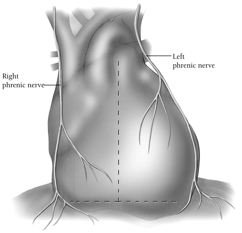 80 J.D. Puskas Figure 2 The pericardium is opened in a generous inverted T incision and divided from the diaphragm broadly.